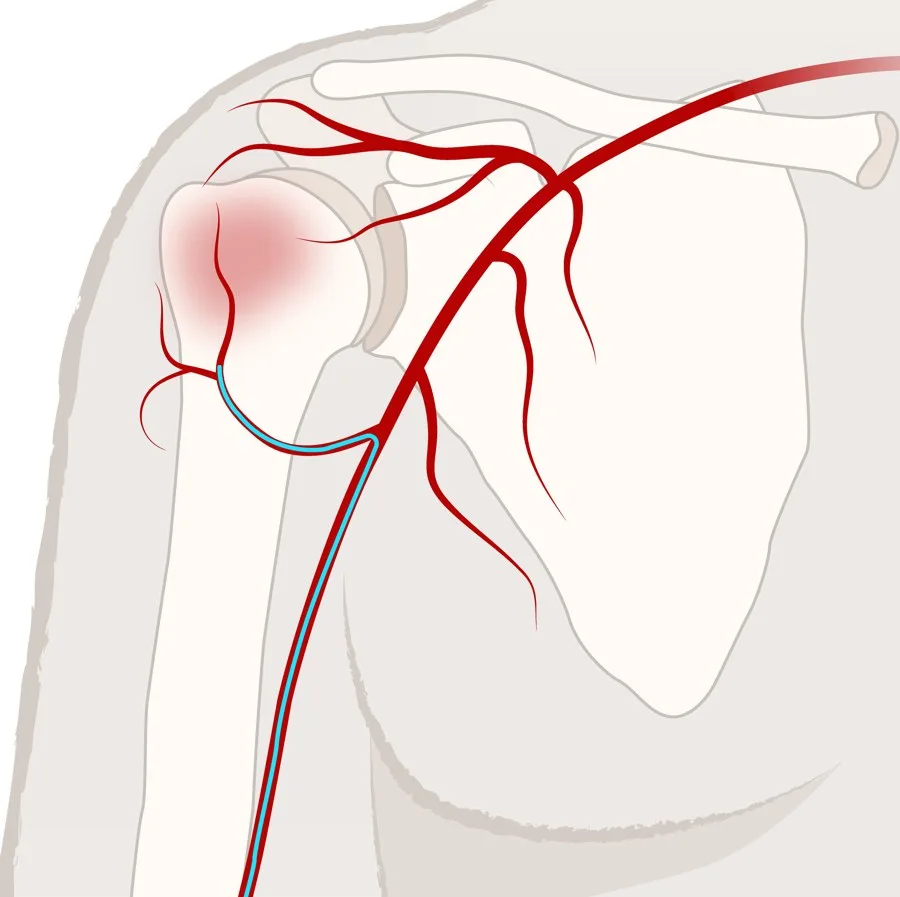 Illustration of an inflamed, painful shoulder joint with abnormal blood vessels — the source of chronic shoulder pain.