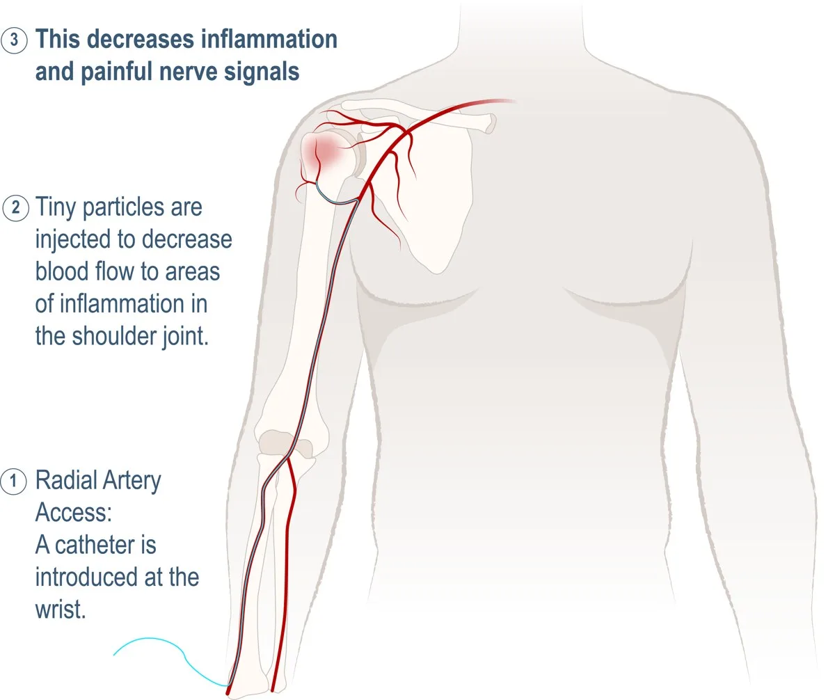 Illustration of shoulder artery embolization: a catheter is introduced at the wrist (radial artery access) and guided to the shoulder, where tiny particles are injected to decrease blood flow to areas of inflammation, reducing pain and painful nerve signals.