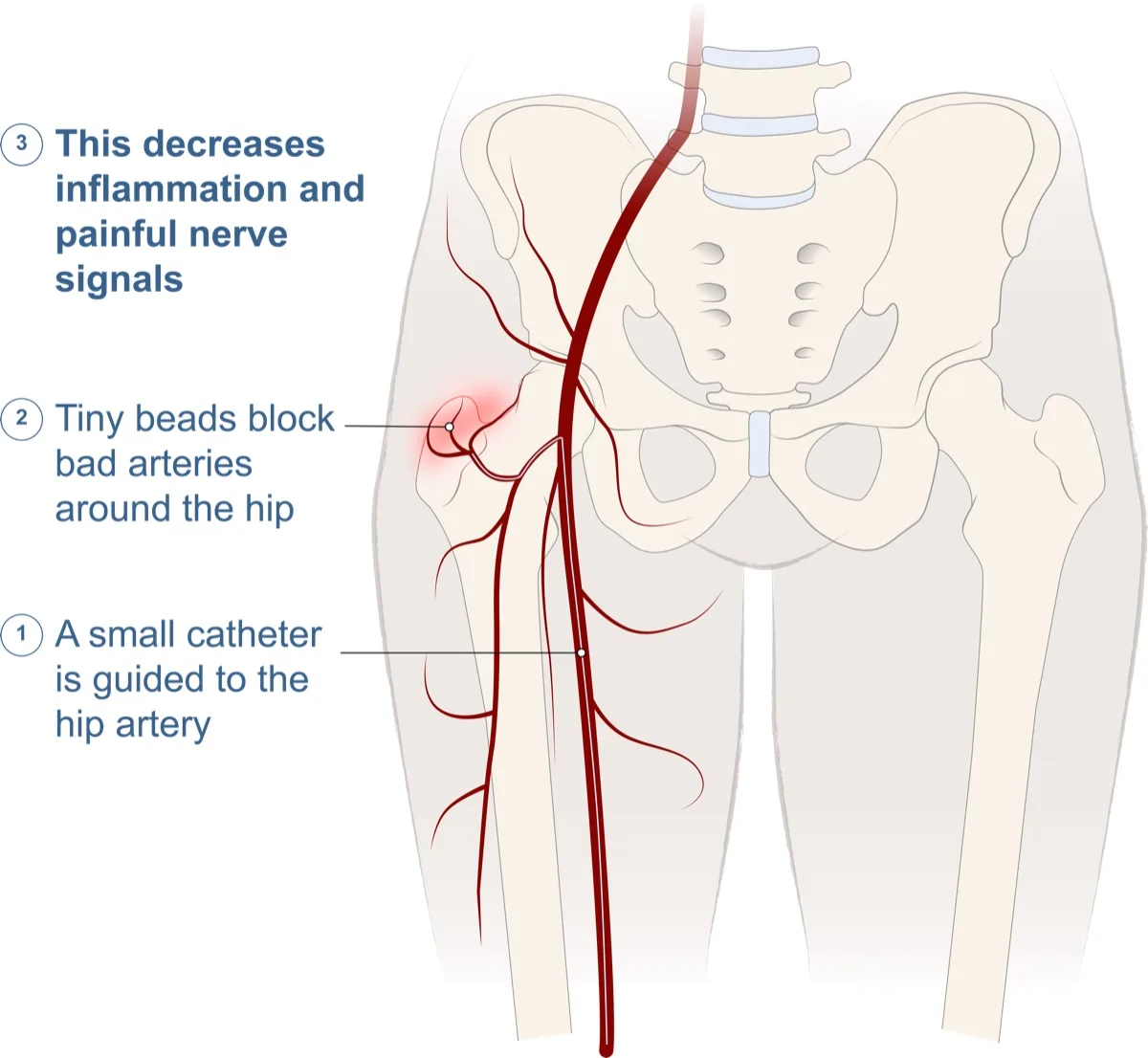 Illustration of hip embolization: a small catheter is guided to the hip artery, tiny beads block the abnormal arteries around the hip, decreasing inflammation and painful nerve signals.