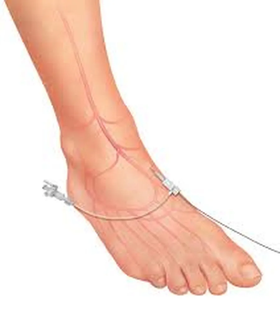 Illustration of the access point: a thin, flexible catheter enters through a tiny pinhole at the top of the foot — similar to having an IV placed.