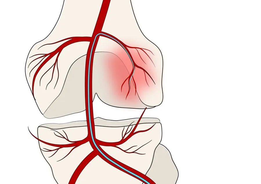 Illustration of an inflamed, painful knee joint with abnormal blood vessels — the source of arthritis knee pain.