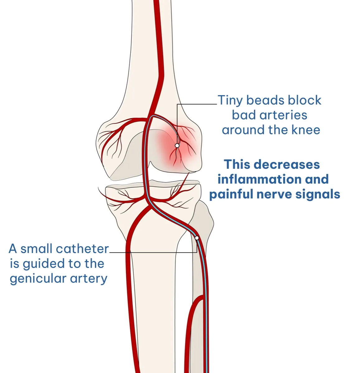 Illustration of genicular artery embolization: a small catheter is guided to the genicular artery, tiny beads block the abnormal arteries around the knee, decreasing inflammation and painful nerve signals.