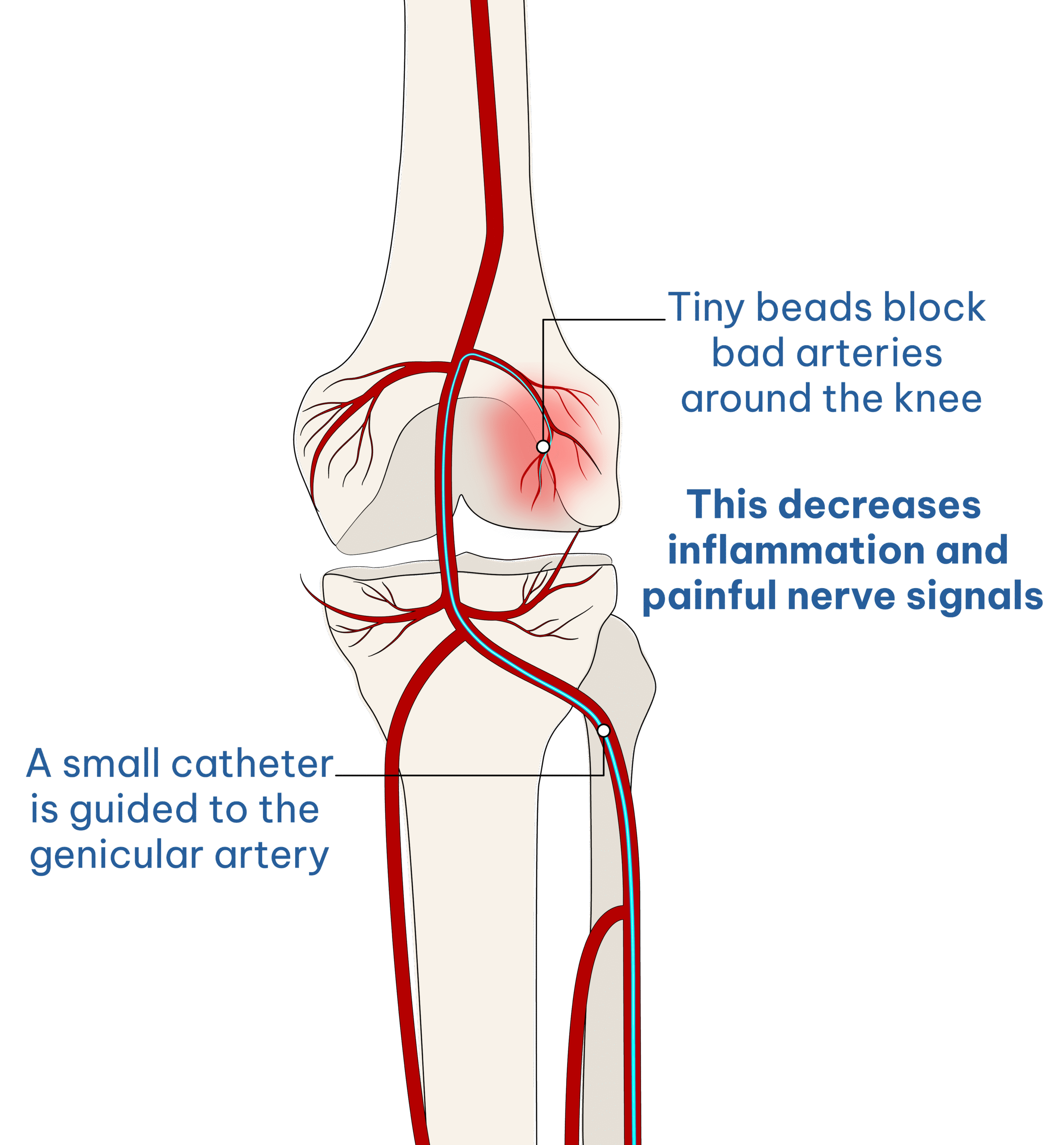 GAE knee embolization medical illustration — catheter guided to the genicular artery, tiny beads block abnormal arteries