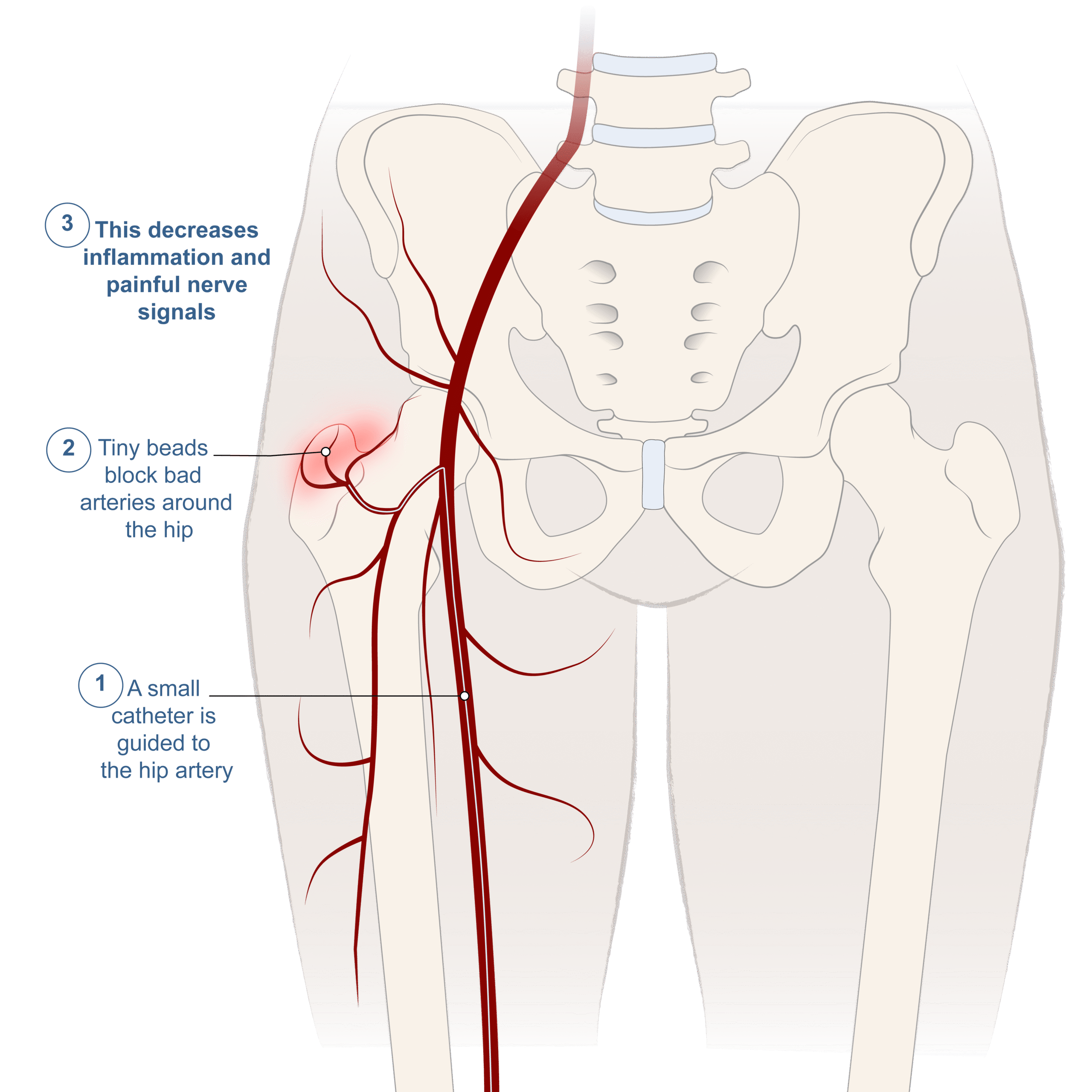 Hip artery embolization medical illustration — catheter guided to the hip artery, tiny beads block abnormal arteries