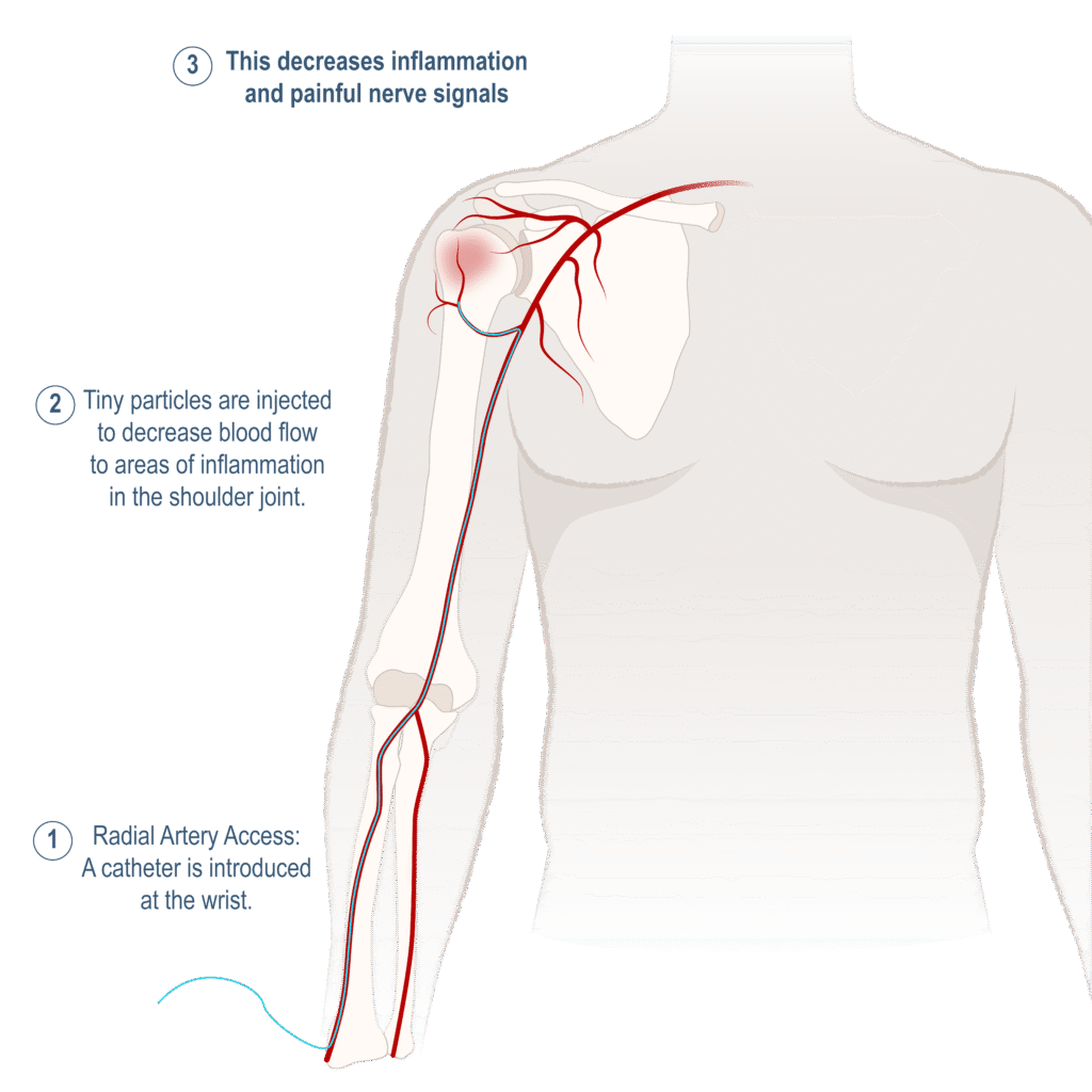 SAE Shoulder Artery Embolization