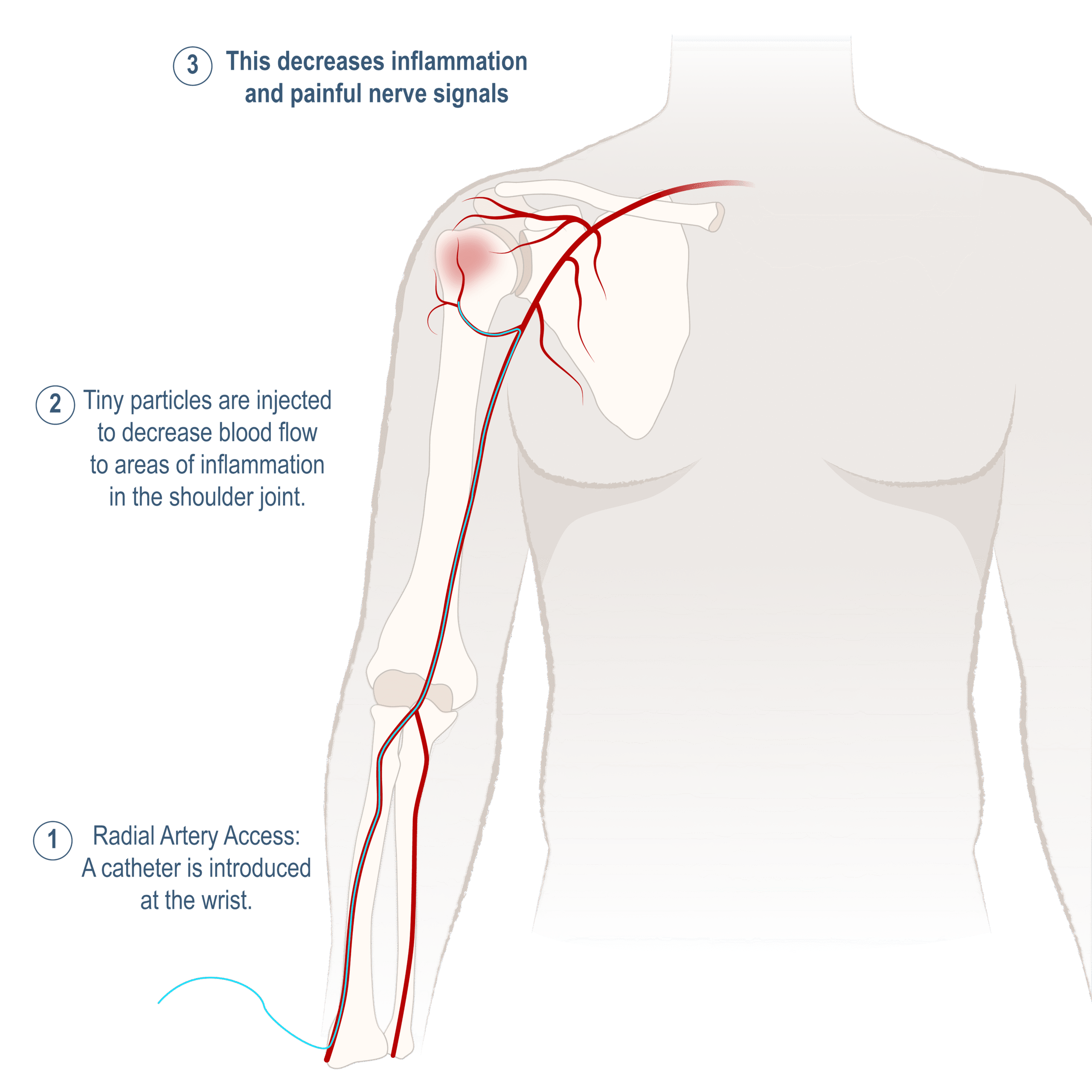 Shoulder artery embolization medical illustration